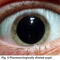 Anticholinergic Pupil